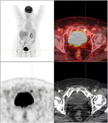 Case report: Intraosseous hibernoma (IOH) mimics osseous metastasis: another rare pitfall in FDG-PET-CT